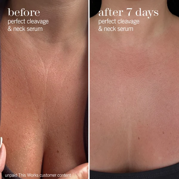 Before and after seven days comparison of the décolletage, with crepey texture looking smoother