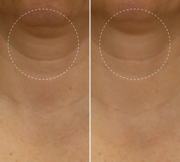 Before and after comparison of the jawline and under-chin area, with the circled zone looking smoother after use