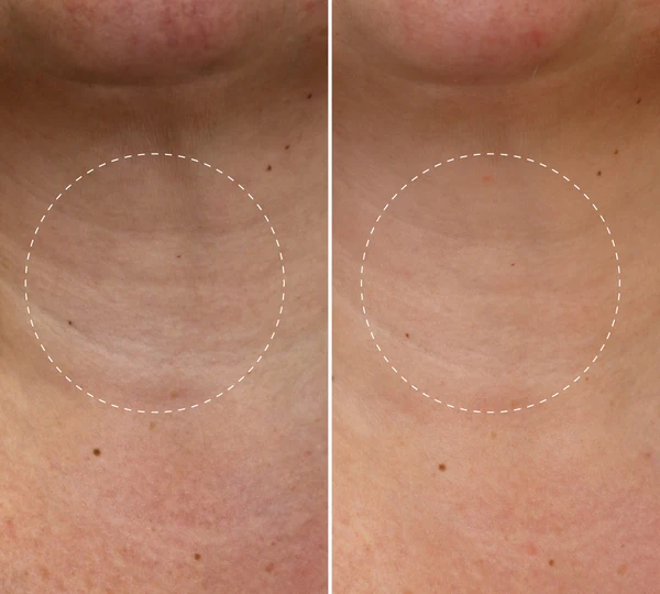 Before and after comparison of horizontal neck lines, with the circled zone looking softer after use